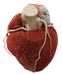 Telerradiologia cardiovascular precisa